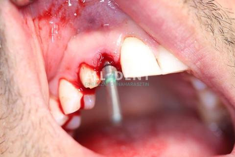 Azonnali implantáció - műtét közben