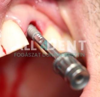 Azonnali implantáció - műtét közben