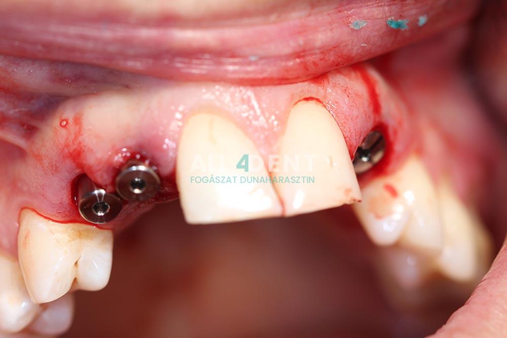Azonnali implantáció - műtét után közvetlenül