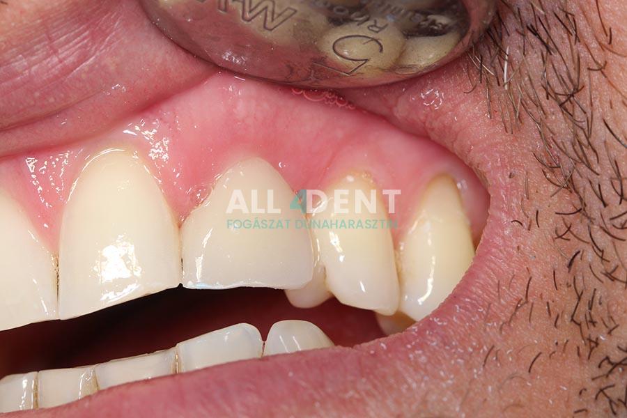 Azonnali implantáció - műtét után 1 héttel