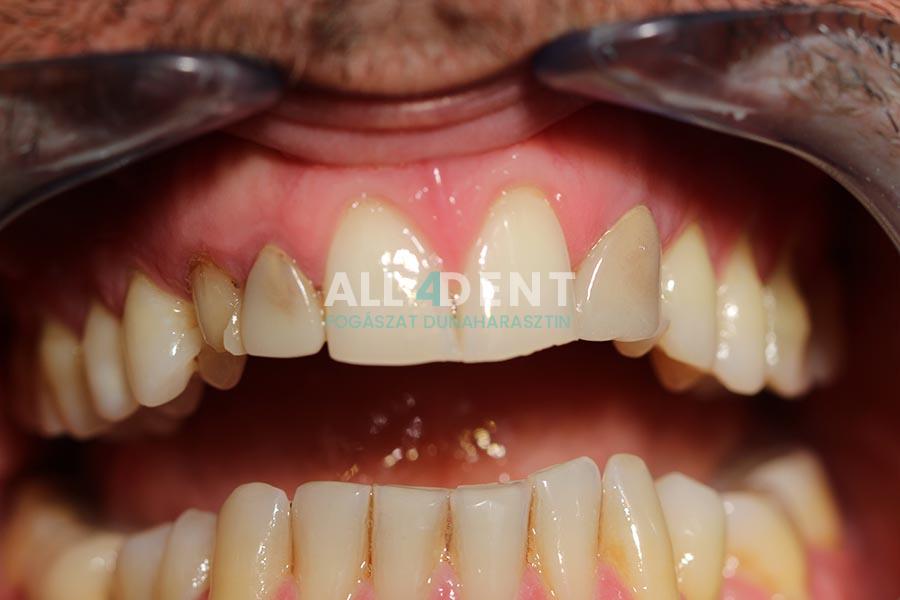 Azonnali implantáció - ilyen volt