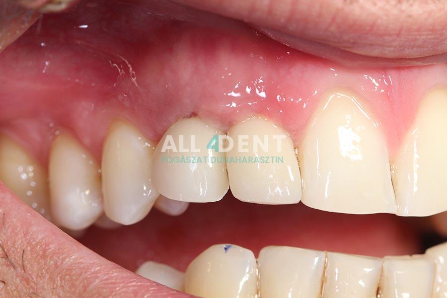 Azonnali implantáció - műtét után 1 héttel